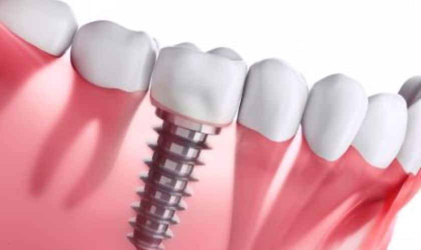 Dental Implants Huntsville